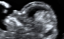 First Trimester Screening